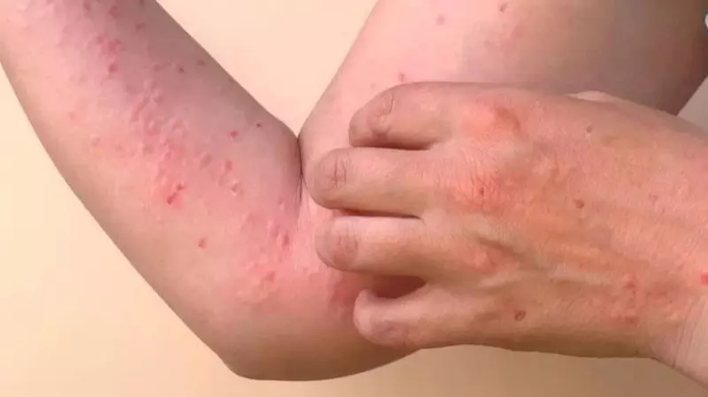 चिकनगुनिया की महामारी आई चीन में, 8 हजार लोग चपेट में | Chikungunya epidemic hits China, 8 thousand people affected |  चिकनगुनिया की महामारी आई चीन में, 8 हजार लोग चपेट में